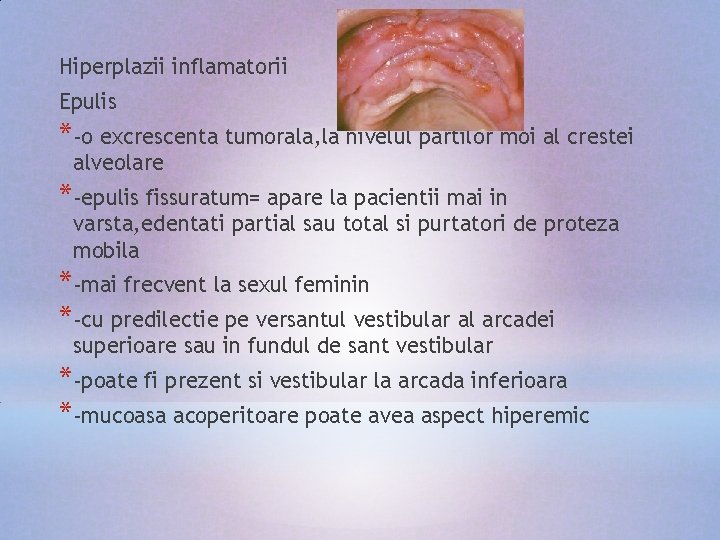 Hiperplazii inflamatorii Epulis *-o excrescenta tumorala, la nivelul partilor moi al crestei alveolare *-epulis