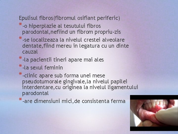 Epulisul fibros(fibromul osifiant periferic) *-o hiperplazie al tesutului fibros parodontal, nefiind un fibrom propriu-zis