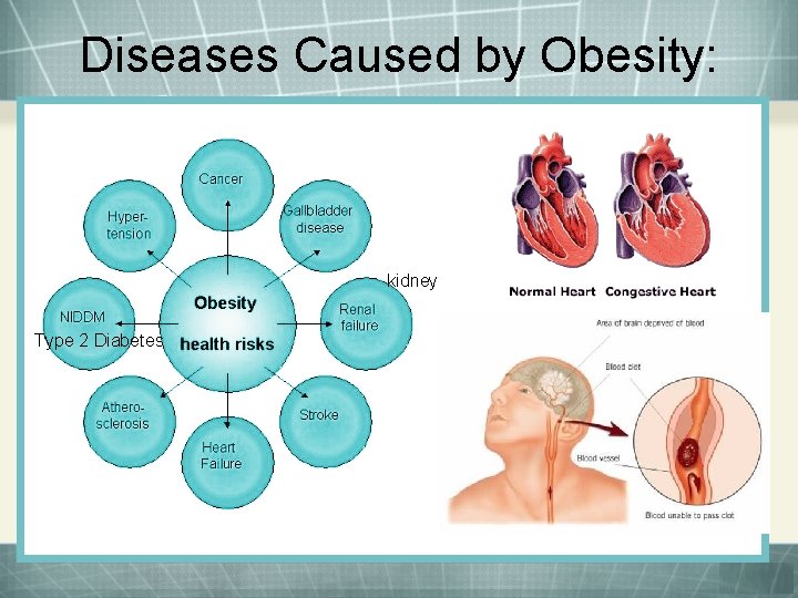 Diseases Caused by Obesity: kidney Type 2 Diabetes 