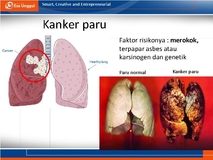 Kanker paru Faktor risikonya : merokok, terpapar asbes atau karsinogen dan genetik Paru normal