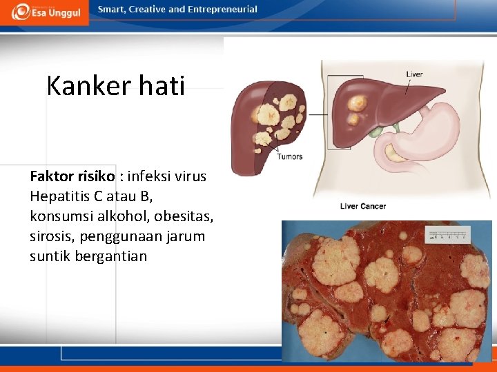 Kanker hati Faktor risiko : infeksi virus Hepatitis C atau B, konsumsi alkohol, obesitas,