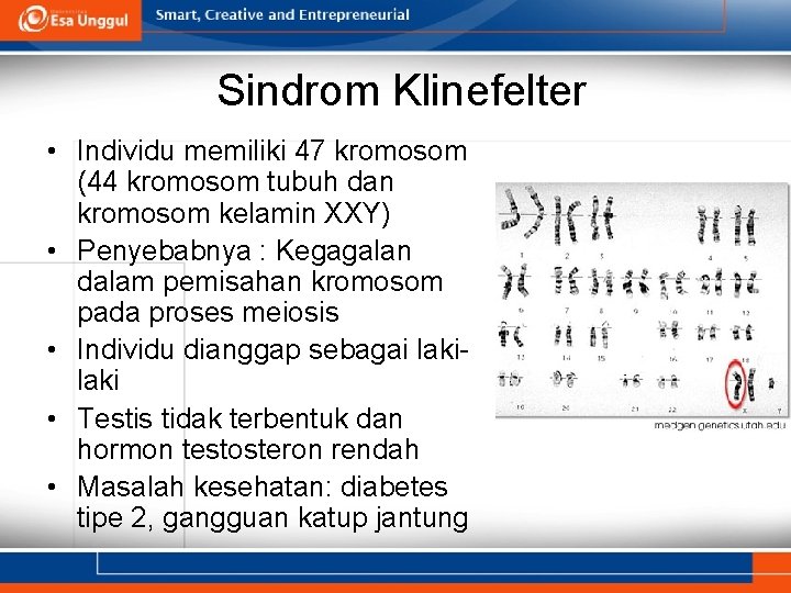 Sindrom Klinefelter • Individu memiliki 47 kromosom (44 kromosom tubuh dan kromosom kelamin XXY)