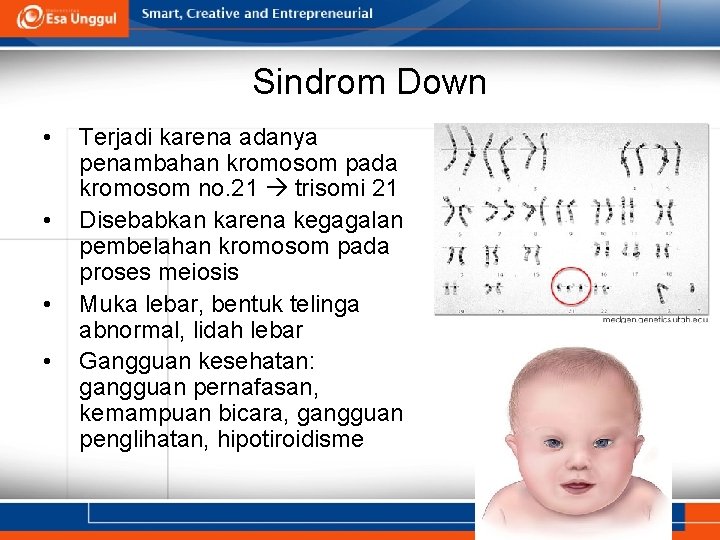 Sindrom Down • • Terjadi karena adanya penambahan kromosom pada kromosom no. 21 trisomi