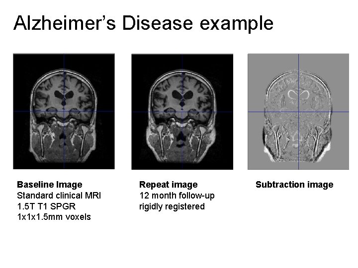 Alzheimer’s Disease example Baseline Image Standard clinical MRI 1. 5 T T 1 SPGR