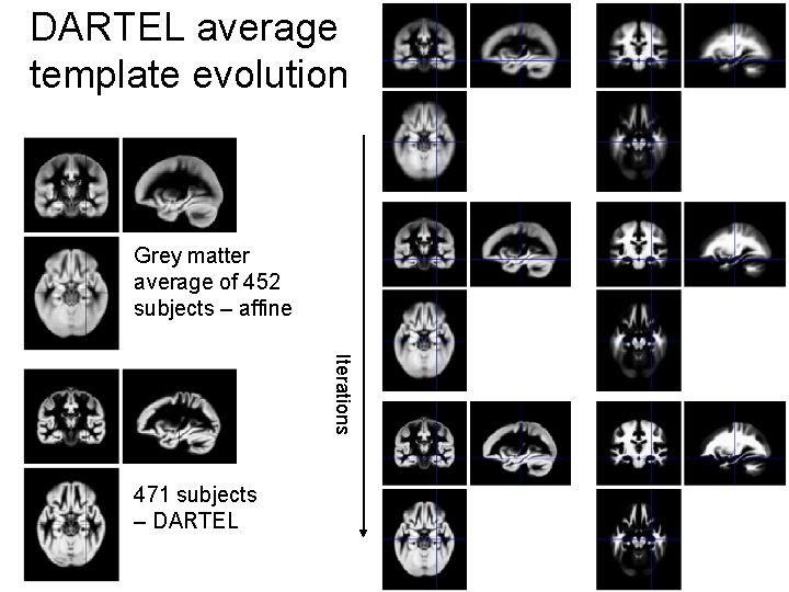 DARTEL average template evolution Grey matter average of 452 subjects – affine Iterations 471