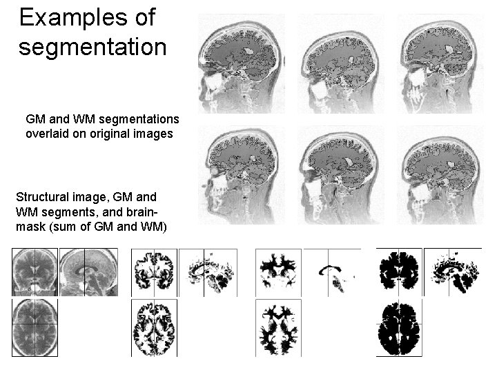 Examples of segmentation GM and WM segmentations overlaid on original images Structural image, GM