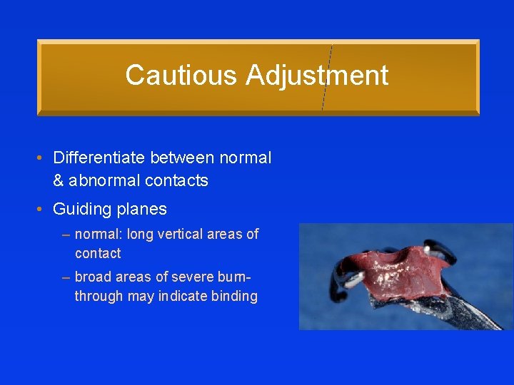 Cautious Adjustment • Differentiate between normal & abnormal contacts • Guiding planes – normal: