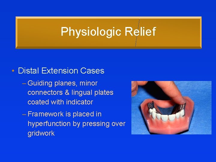 Physiologic Relief • Distal Extension Cases – Guiding planes, minor connectors & lingual plates