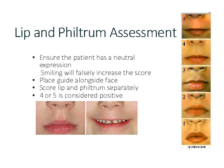 Lip and Philtrum Assessment • Ensure the patient has a neutral expression Smiling will