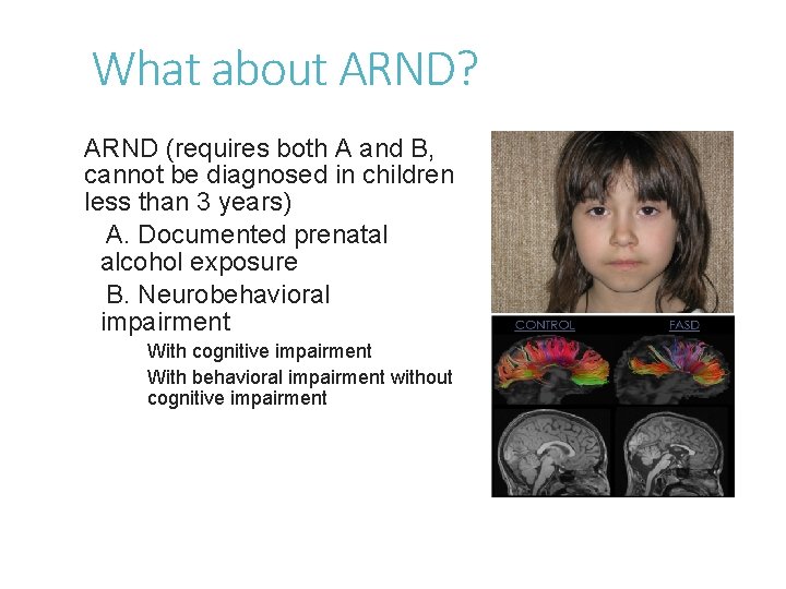 What about ARND? ARND (requires both A and B, cannot be diagnosed in children