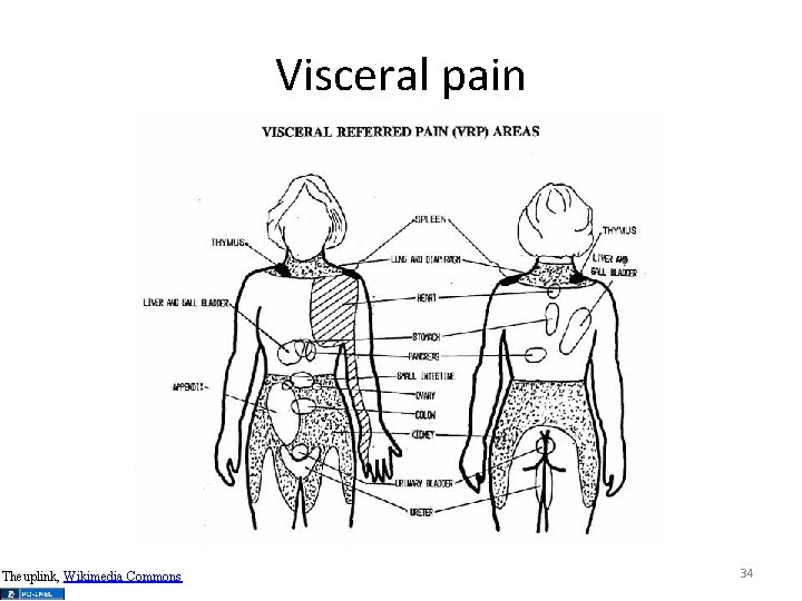 Visceral pain Theuplink, Wikimedia Commons 34 