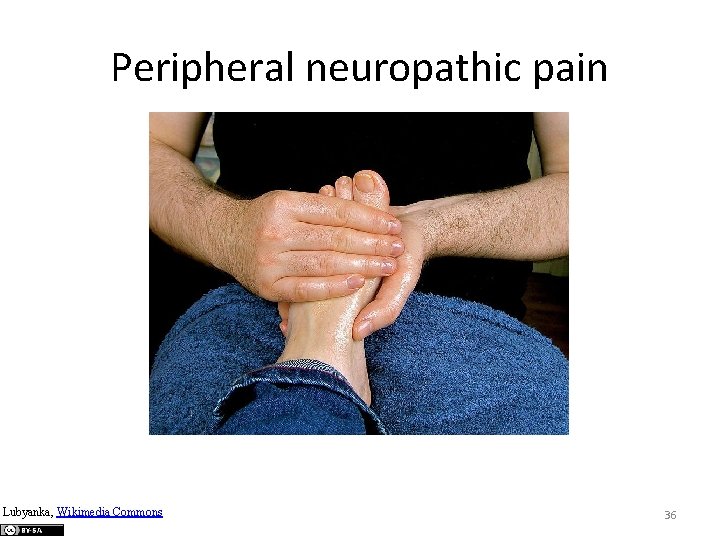 Peripheral neuropathic pain Lubyanka, Wikimedia Commons 36 