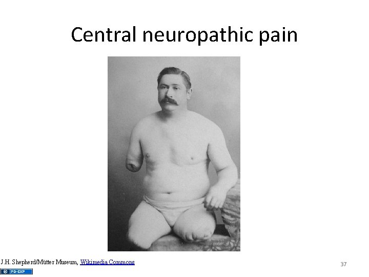 Central neuropathic pain J. H. Shepherd/Mütter Museum, Wikimedia Commons 37 