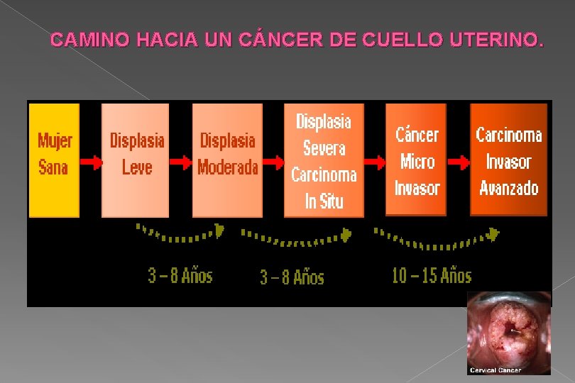 CAMINO HACIA UN CÁNCER DE CUELLO UTERINO. 