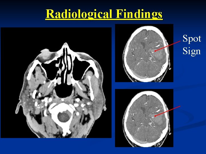 Radiological Findings Spot Sign 