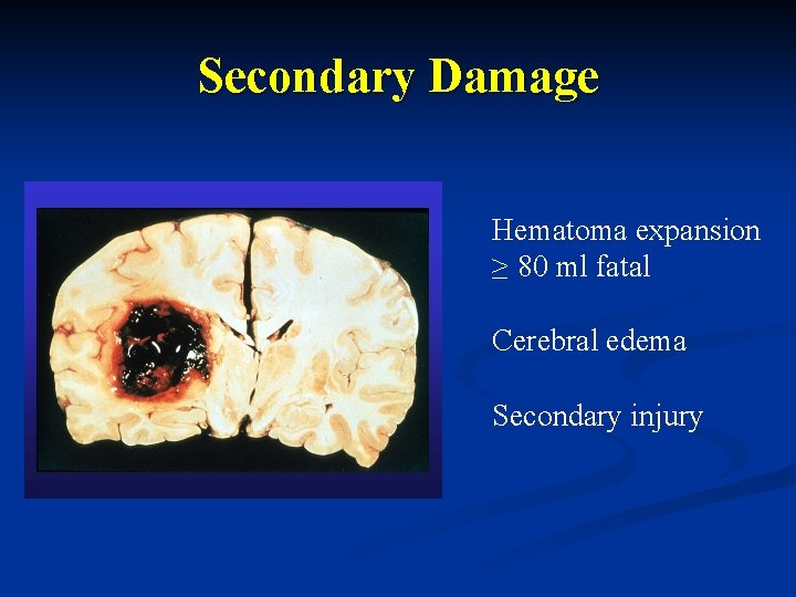 Secondary Damage Hematoma expansion ≥ 80 ml fatal Cerebral edema Secondary injury 