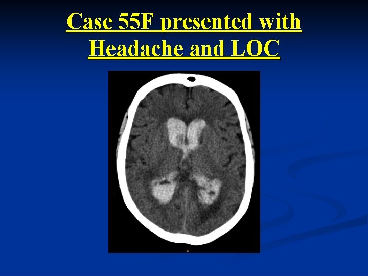 Case 55 F presented with Headache and LOC 