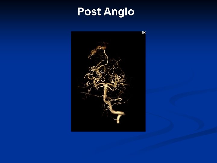 Post Angio 