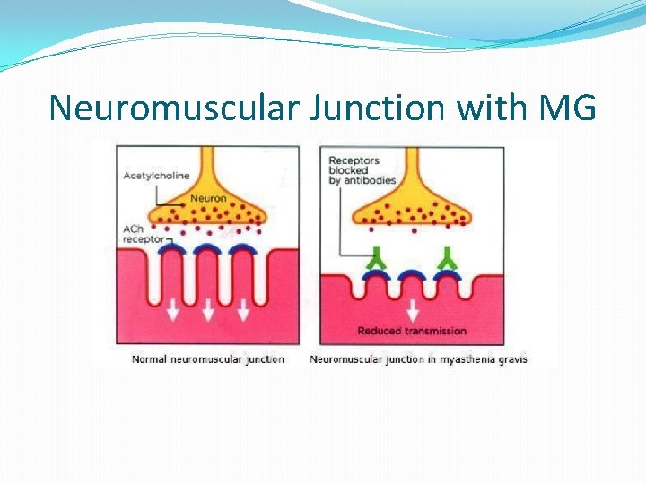 Neuromuscular Junction with MG 