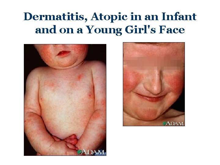 Dermatitis, Atopic in an Infant and on a Young Girl's Face 