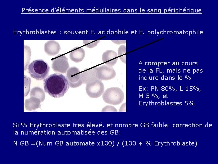 Présence d’éléments médullaires dans le sang périphérique Erythroblastes : souvent E. acidophile et E.