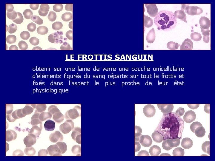 LE FROTTIS SANGUIN obtenir sur une lame de verre une couche unicellulaire d'éléments figurés