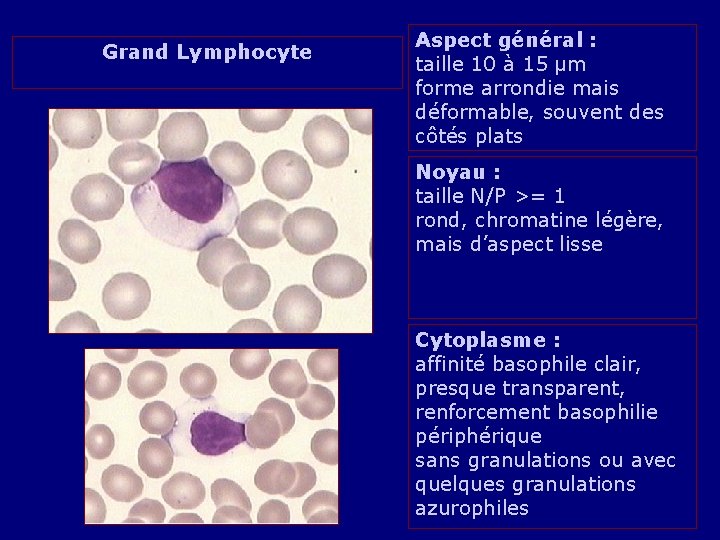 Grand Lymphocyte Aspect général : taille 10 à 15 µm forme arrondie mais déformable,