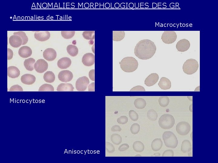 ANOMALIES MORPHOLOGIQUES DES GR • Anomalies de Taille Microcytose Anisocytose Macrocytose 