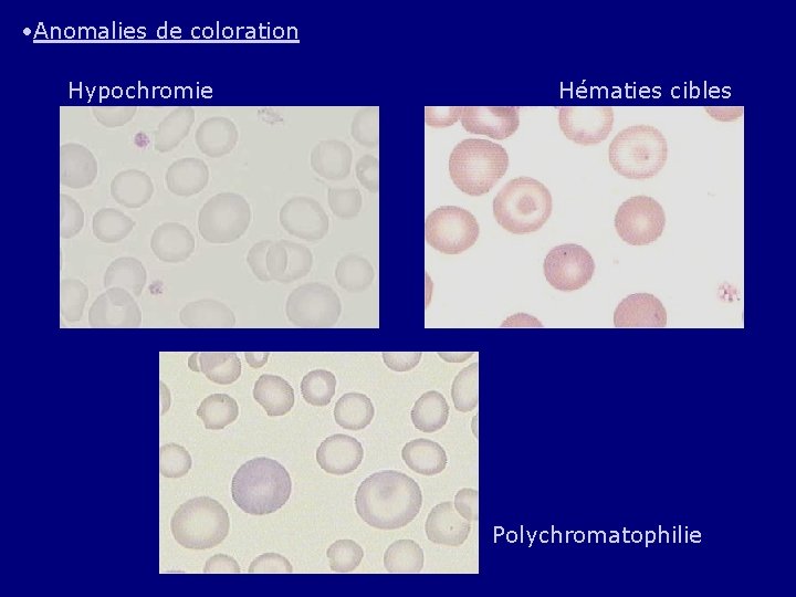  • Anomalies de coloration Hypochromie Hématies cibles Polychromatophilie 