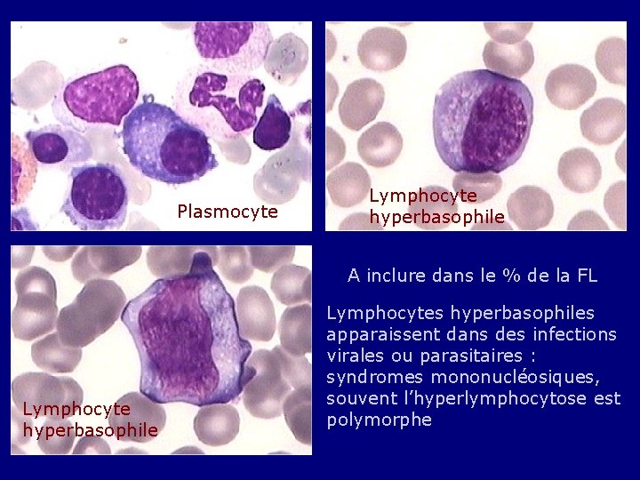 Plasmocyte Lymphocyte hyperbasophile A inclure dans le % de la FL Lymphocyte hyperbasophile Lymphocytes