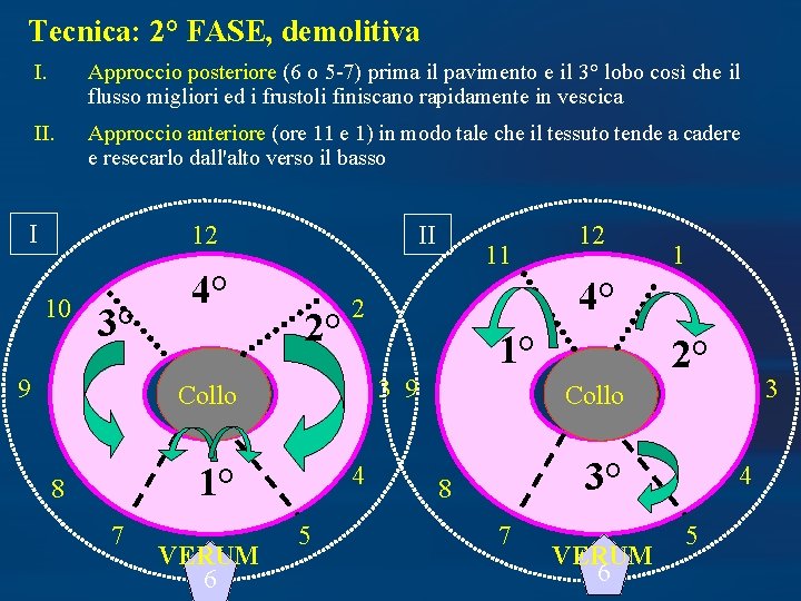 Tecnica: 2° FASE, demolitiva I. Approccio posteriore (6 o 5 -7) prima il pavimento