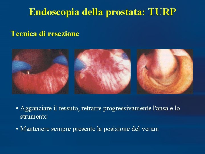 Endoscopia della prostata: TURP Tecnica di resezione • Agganciare il tessuto, retrarre progressivamente l'ansa