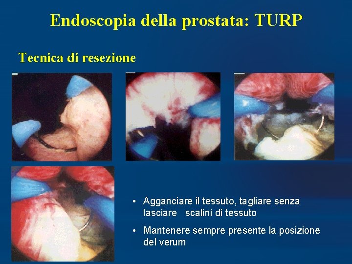 Endoscopia della prostata: TURP Tecnica di resezione • Agganciare il tessuto, tagliare senza lasciare