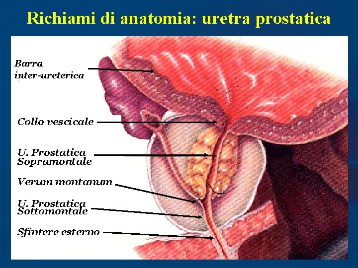 Richiami di anatomia: uretra prostatica Barra inter-ureterica Collo vescicale U. Prostatica Sopramontale Verum montanum