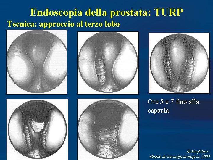 Endoscopia della prostata: TURP Tecnica: approccio al terzo lobo Ore 5 e 7 fino