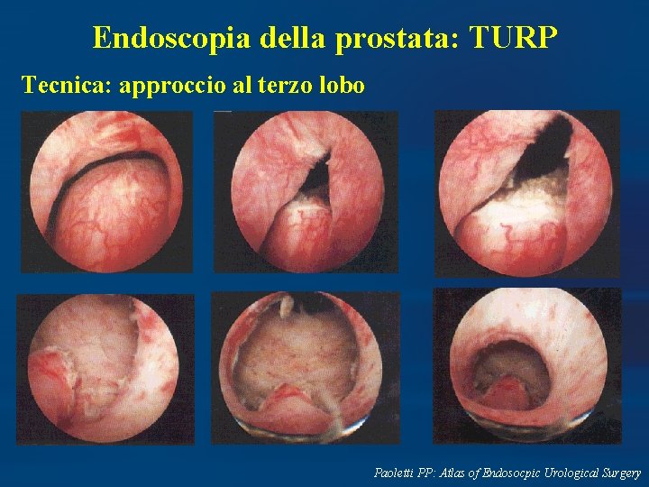 Endoscopia della prostata: TURP Tecnica: approccio al terzo lobo Paoletti PP: Atlas of Endosocpic
