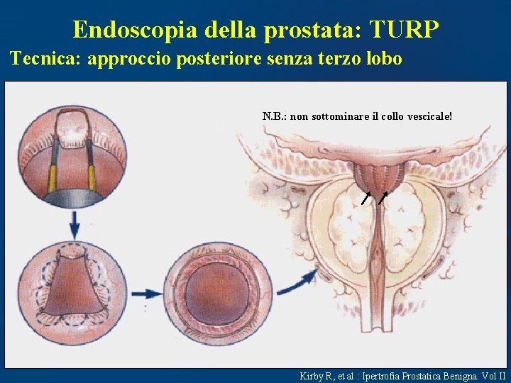 Endoscopia della prostata: TURP Tecnica: approccio posteriore senza terzo lobo N. B. : non