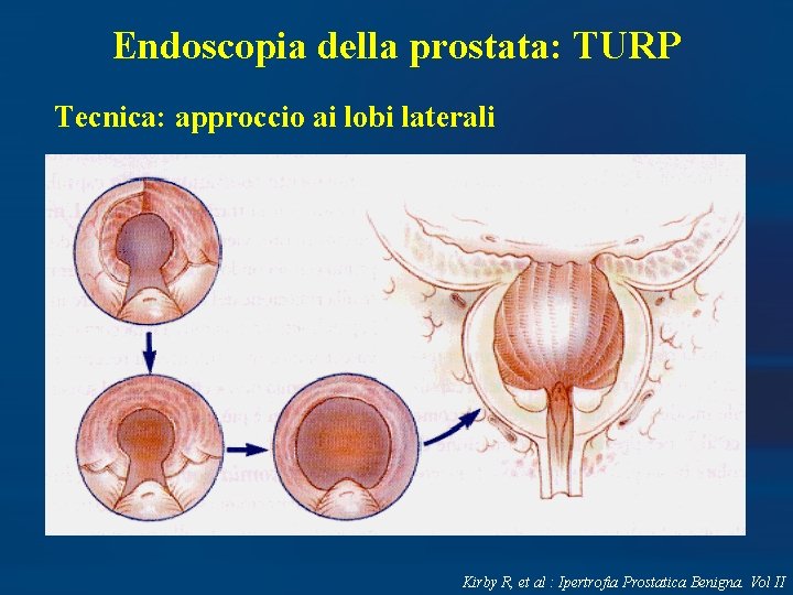 Endoscopia della prostata: TURP Tecnica: approccio ai lobi laterali Kirby R, et al :