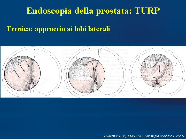 Endoscopia della prostata: TURP Tecnica: approccio ai lobi laterali Dubernard JM, Abbou CC: Chirurgia