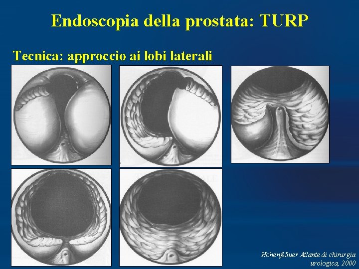 Endoscopia della prostata: TURP Tecnica: approccio ai lobi laterali Hohenfelluer Atlante di chirurgia urologica,