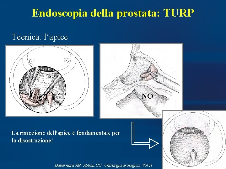 Endoscopia della prostata: TURP Tecnica: l’apice NO La rimozione dell'apice è fondamentale per la