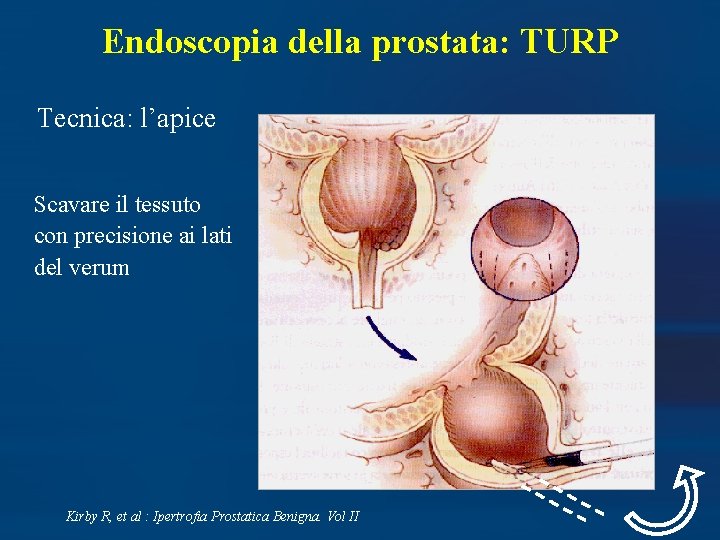 Endoscopia della prostata: TURP Tecnica: l’apice Scavare il tessuto con precisione ai lati del