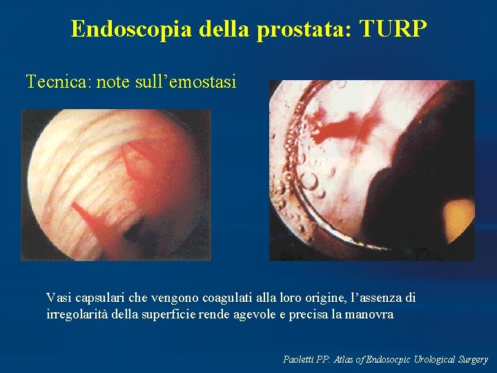 Endoscopia della prostata: TURP Tecnica: note sull’emostasi Vasi capsulari che vengono coagulati alla loro