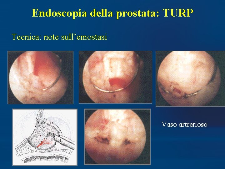 Endoscopia della prostata: TURP Tecnica: note sull’emostasi Vaso artrerioso 