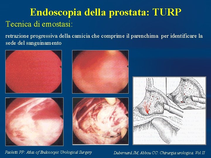 Endoscopia della prostata: TURP Tecnica di emostasi: retrazione progressiva della camicia che comprime il