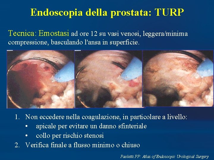 Endoscopia della prostata: TURP Tecnica: Emostasi ad ore 12 su vasi venosi, leggera/minima compressione,