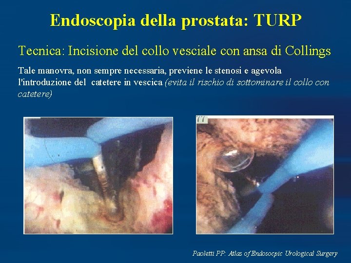 Endoscopia della prostata: TURP Tecnica: Incisione del collo vesciale con ansa di Collings Tale