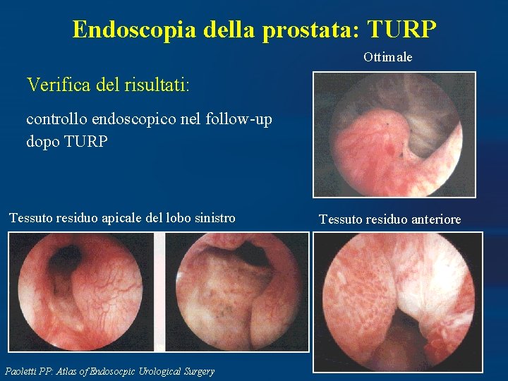 Endoscopia della prostata: TURP Ottimale Verifica del risultati: controllo endoscopico nel follow-up dopo TURP