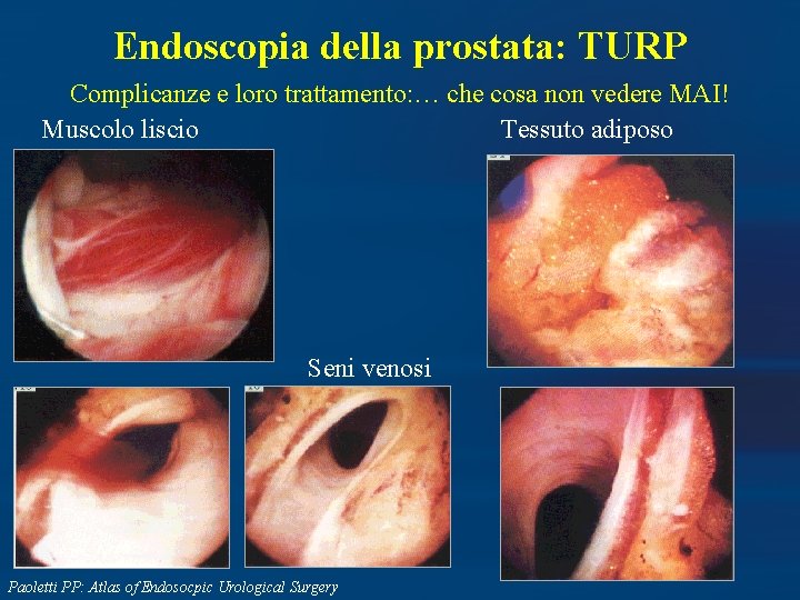 Endoscopia della prostata: TURP Complicanze e loro trattamento: … che cosa non vedere MAI!