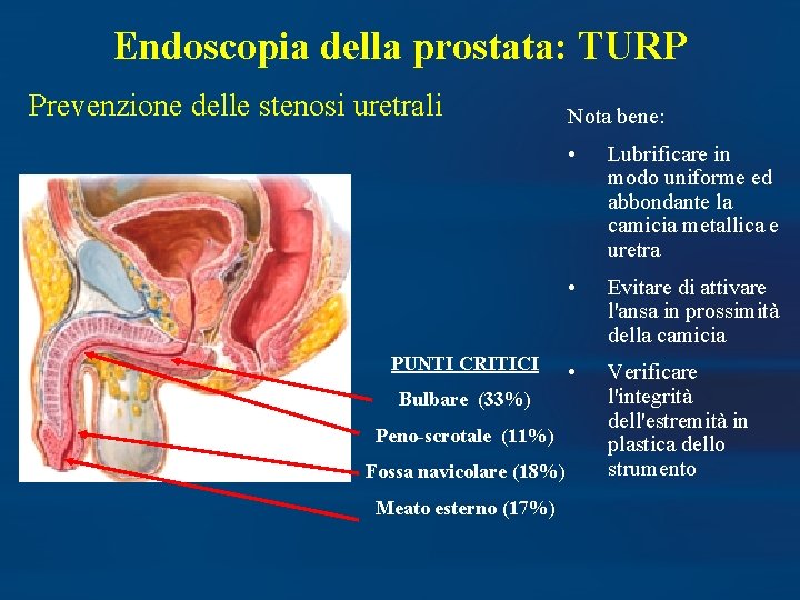 Endoscopia della prostata: TURP Prevenzione delle stenosi uretrali PUNTI CRITICI Bulbare (33%) Peno-scrotale (11%)